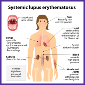 Systemic lupus erythematosus (SLE or lupus)